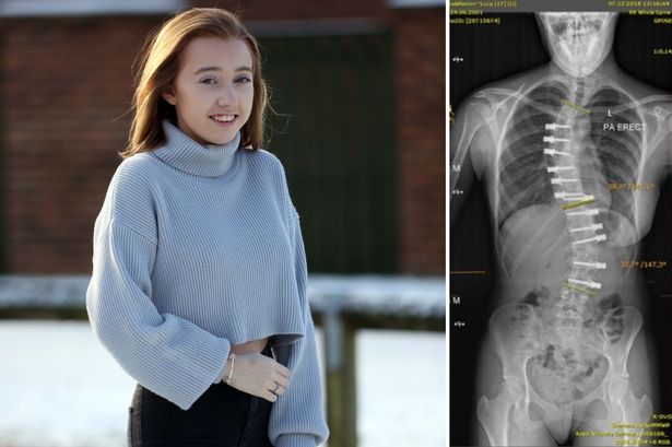 More information about "Heartbreaking setback for girl with S-shaped spine who underwent life-changing surgery in Germany"